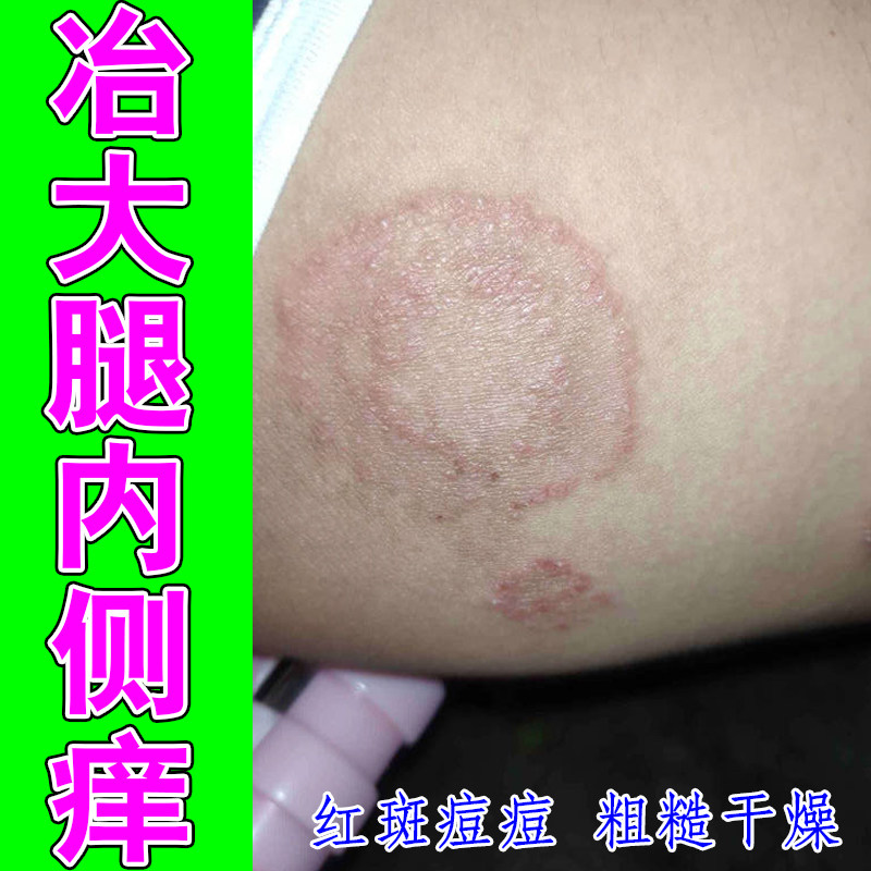 冶大腿内侧痒红肿过敏干燥粗糙男人下面痒皮肤过敏长红斑外用修护