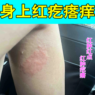 身上红疙瘩痒长痘痘紫外线过敏痒丘长痘痘皮肤红肿荨麻专用草本