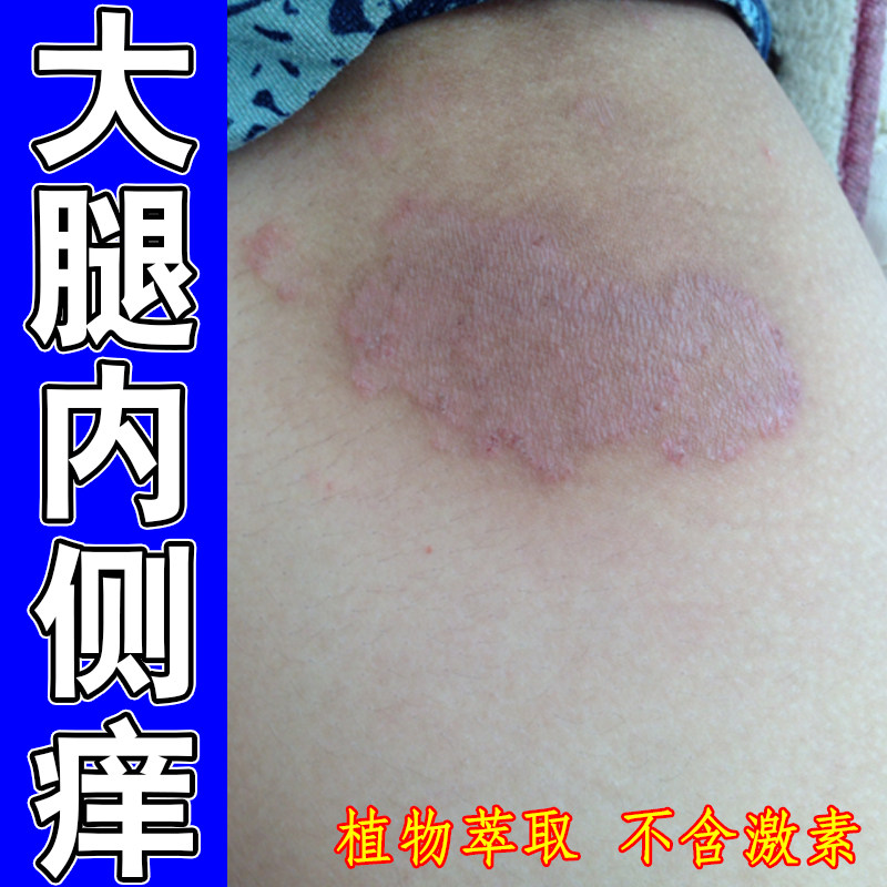 大腿内侧痒屁股根部感染红肿痒起红斑疙瘩痘阴囊潮湿男人私处红痒