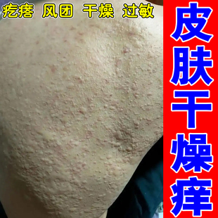 老年人皮肤痒老人全身干痒大腿内侧干燥痒前胸后背长痘痘疙瘩刺挠
