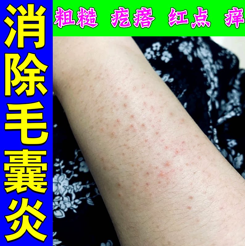 手臂毛囊皮肤凸起小红点长痘痘毛囊堵塞毛囊角化痘痘专用喷雾