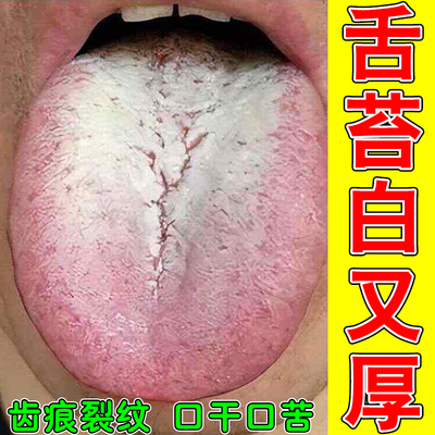 舌苔白厚有裂纹长期口干发涩难受异常草本药剂温和舒缓减轻舌部僵
