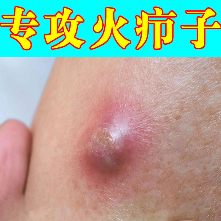 皮脂腺囊肿专用乳药皮下长硬块脓包摸起来疼有痒感屁股坐板