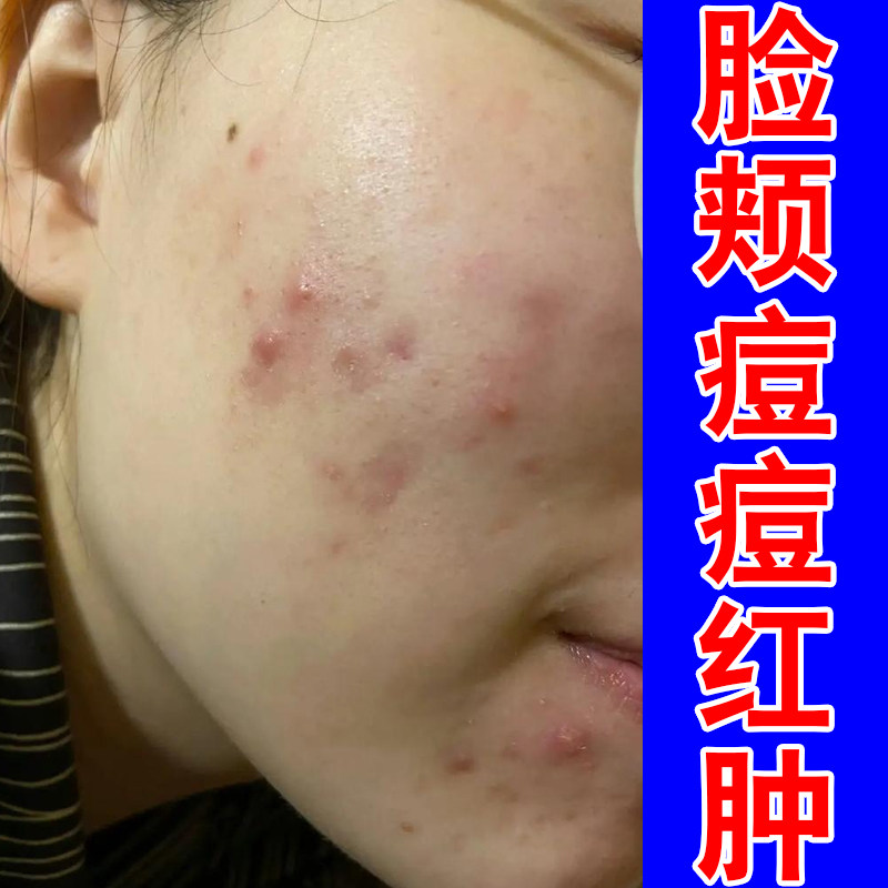脸颊痘痘红肿额头脓包痘长硬块毛囊闭口粉刺小疙瘩下巴反复青春痘
