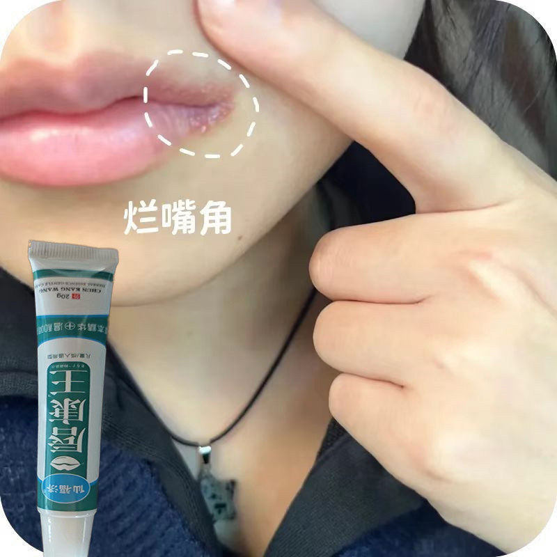 烂嘴角膏药唇周疱针嘴巴干裂脱皮上火嘴角开裂起泡红肿口周裂专用