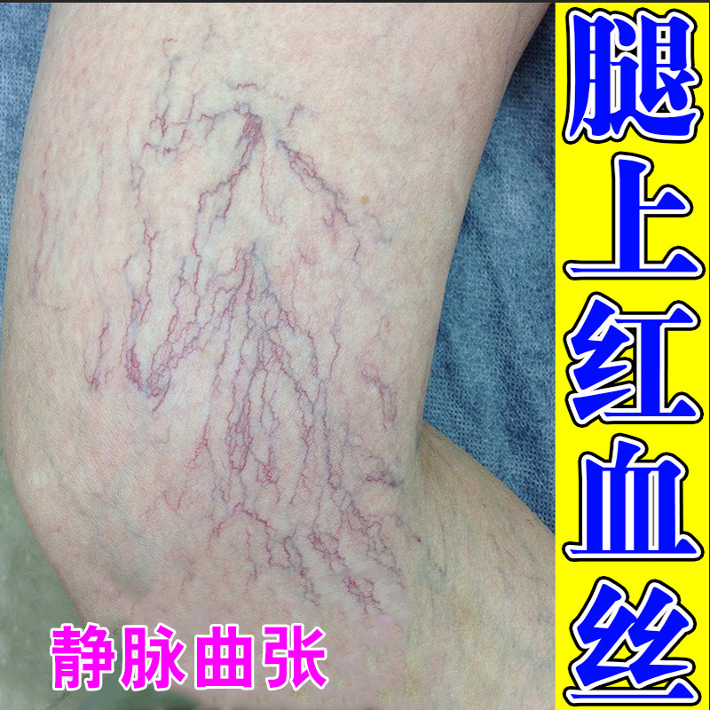 专用膏腿上有红血丝青筋凸起血管堵塞修复老烂腿酸胀软膏