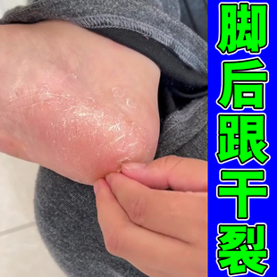 脚后跟干裂手脚脱皮防裂脱皮修护手脚脱皮脚干燥裂口子
