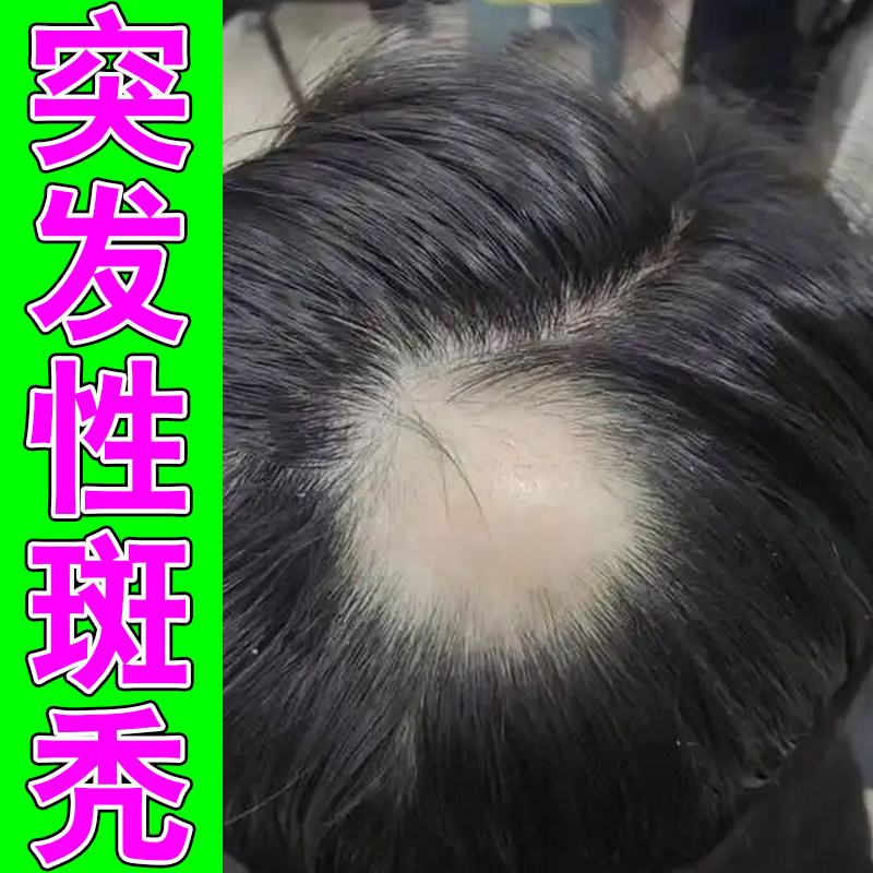 多处斑秃多处秃斑头皮调理液草本滋养改善头部多处片状脱发修护药