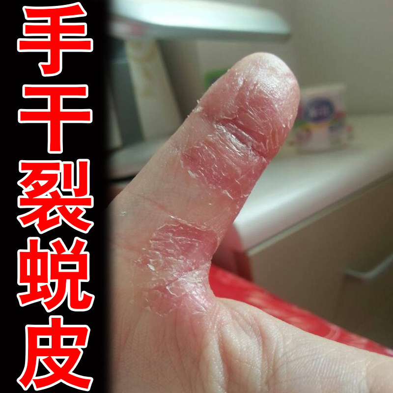 手干裂蜕皮手指头粗糙干燥裂口子手脱皮真菌手指爆皮去角质保湿膏
