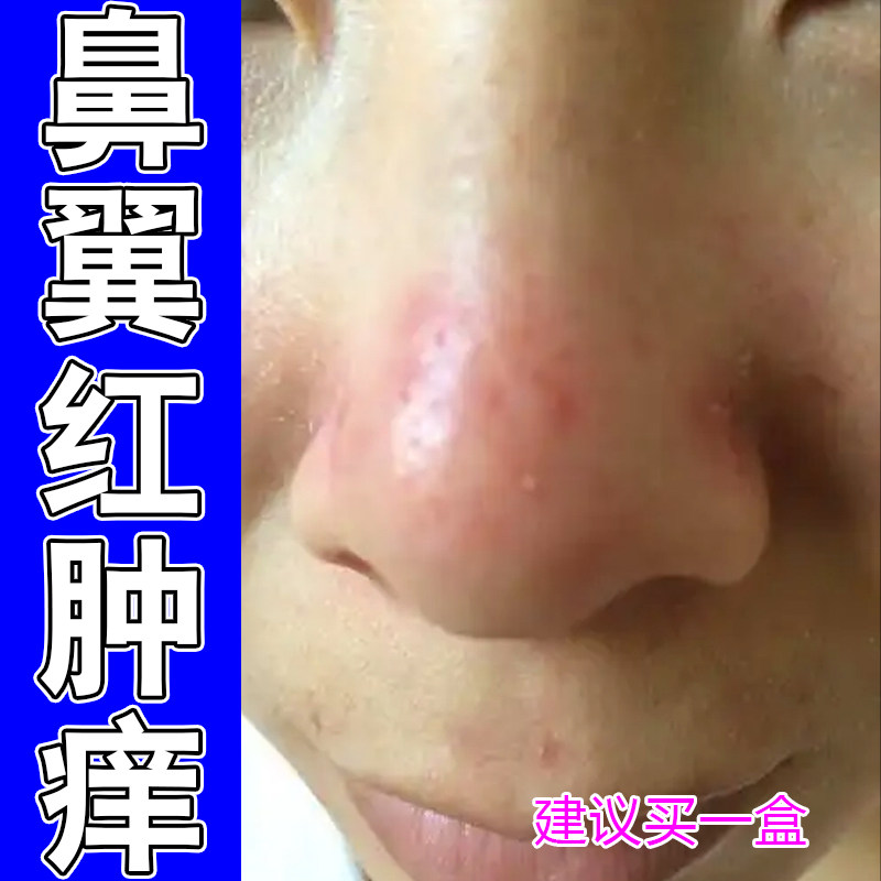 鼻翼红肿痒掉屑脱皮脂溢性过敏痒皮肤消毒护理（消）