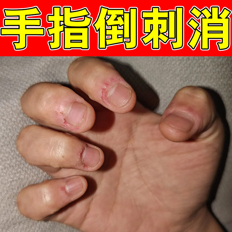 手指倒刺消肉刺皮肤干燥粗糙起皮去死皮去角质边缘开裂修护保湿药