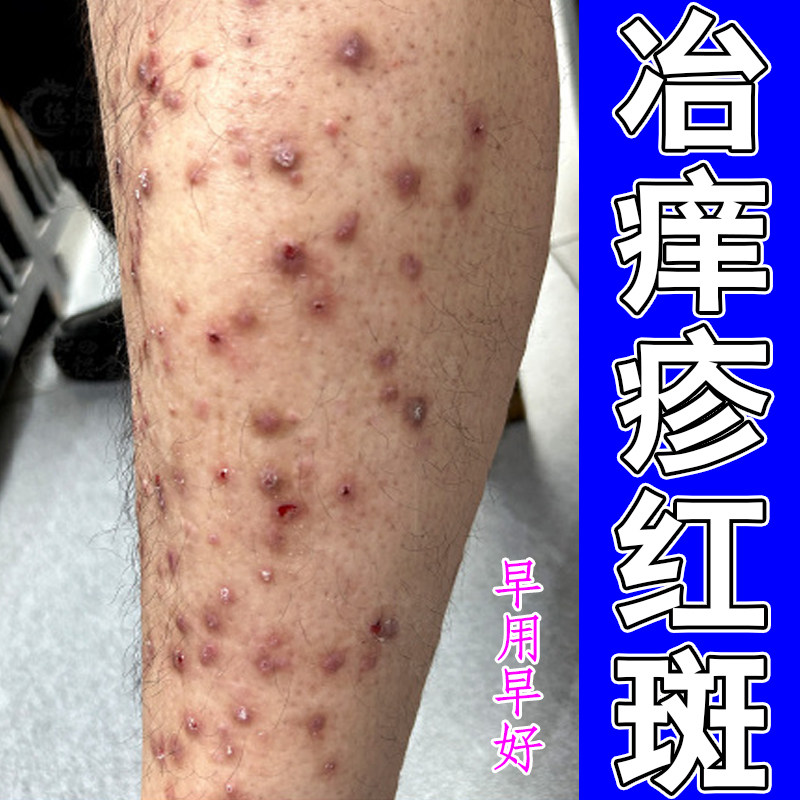腿上蚊虫叮咬抓挠破结痂跳蚤咬感染痒疹身上长硬块疙瘩痘过敏粗糙