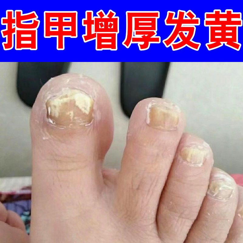 脚指甲增厚变黄甲神器脚趾甲变厚发黄变硬黄指甲盖坏甲变好甲药液