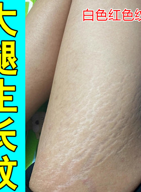 去肥胖纹修复霜生长纹消除学生大腿淡化妊娠纹红白纹路祛肚皮膏乳