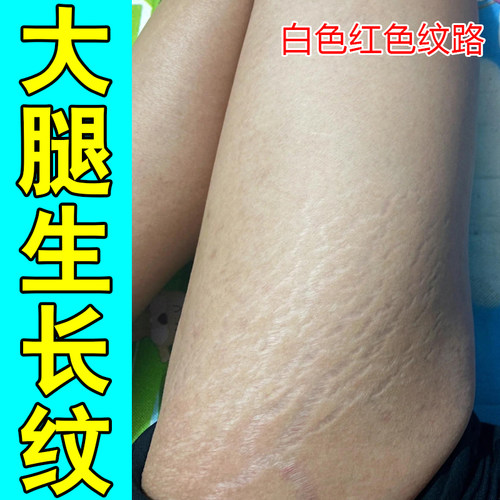 去肥胖纹修复霜生长纹消除学生大腿淡化妊娠纹红白纹路祛肚皮膏乳