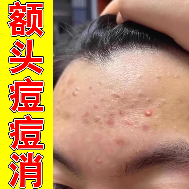 额头痘痘消红肿脓包痘毛囊堵塞毛孔粗大脸上红肿颗粒粉刺闭口修护