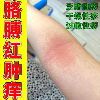 胳膊红肿痒大腿内侧痒修复药乳膏