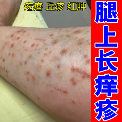手背腿上长红疙瘩硬疙瘩保湿药乳