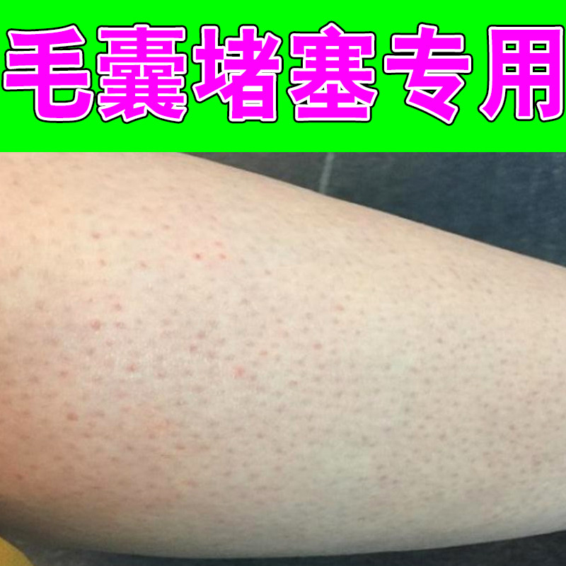 毛囊堵塞专用皮肤干燥长小颗粒起痘毛孔粗大手臂长小疙瘩外用修护