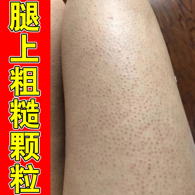 腿上粗糙颗粒毛周角化长小疙瘩毛囊堵塞长黑点黑色素沉淀去角质膏