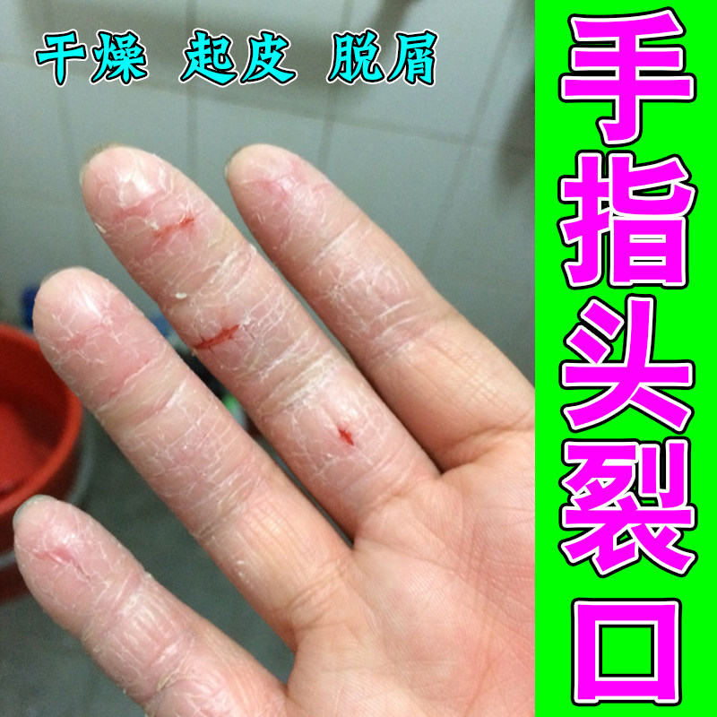 手指头裂口秋冬季手指缝开裂脱皮疼痛手足皲裂手脱皮真菌感染外用