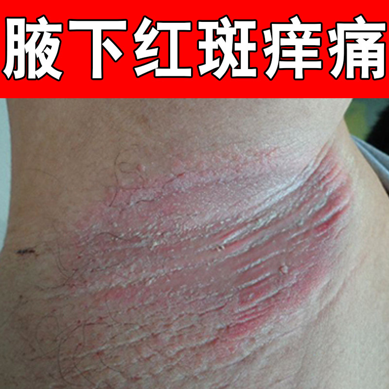 腋下红斑痒痛汗斑皮肤起小疙瘩颗粒痘脓包胳肢窝有异味出汗多红肿
