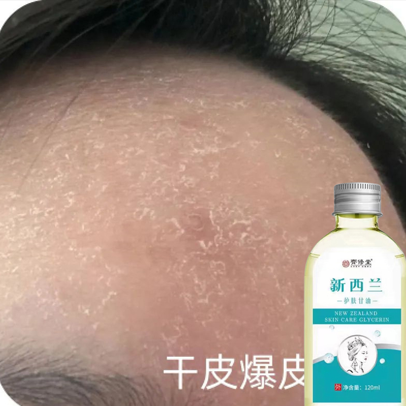 脸上长皮脸上皮面部脸痒脸上起皮干燥脸干掉皮脸部过敏脸痒去痒药