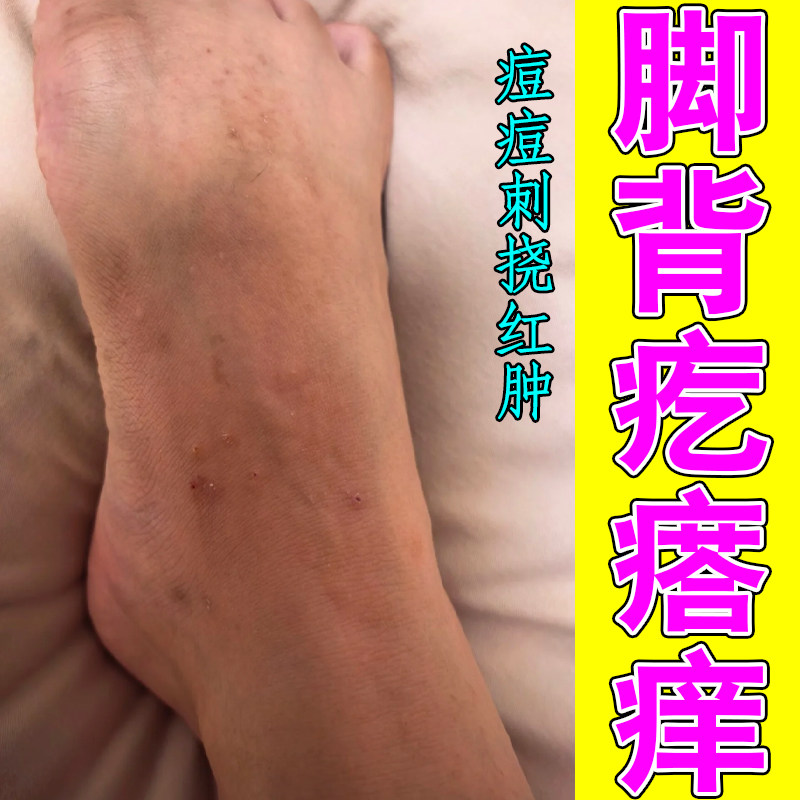 脚背疙瘩痒脚背红肿干燥痒掉屑脚底脱皮长水泡老年人皮肤痒刺挠抓