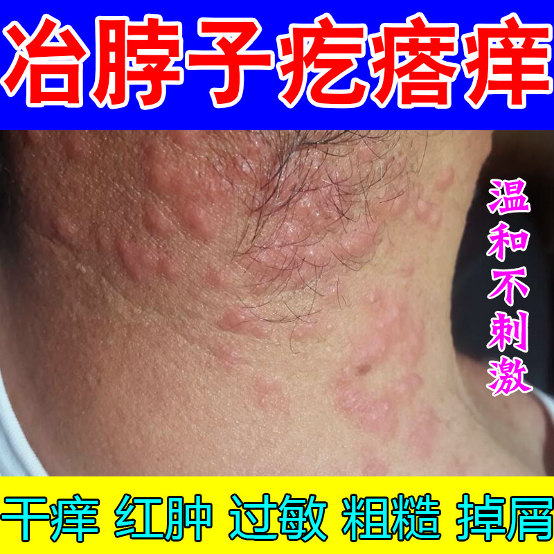 冶脖子疙瘩痒皮肤干燥红肿粗糙紫外线过敏特应性掉屑脖颈后面增厚