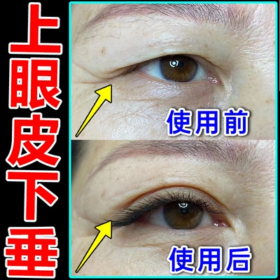 眼皮下垂提拉眼贴上眼皮松弛提拉紧致眼肌无力双眼皮贴大小眼神器