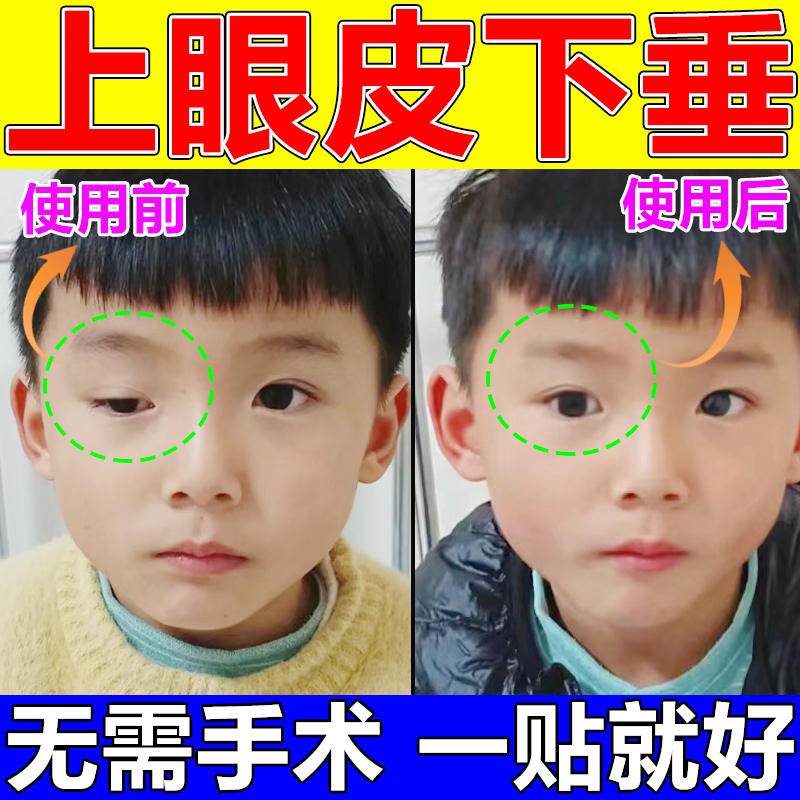 眼皮下垂提拉贴双眼皮神器老年人松弛紧致怎么办去肿定型上睑专用