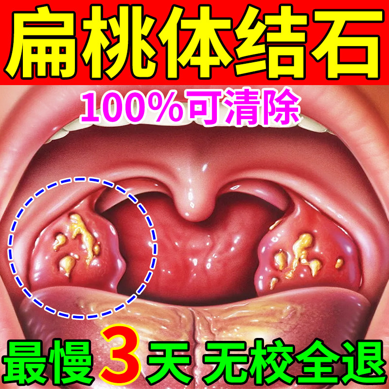扁桃体结石去除工具口腔咽喉异物感咽喉清理口臭隐窝冲洗喷剂神器