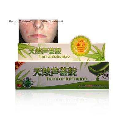 Acne sooe gel remove pomples Greatment eczema