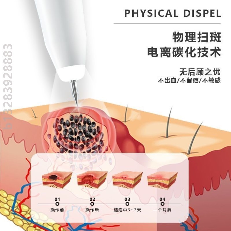 点痣笔祛斑笔无痛去痣神器美容修复脸部全身无痕激光美容仪器家用