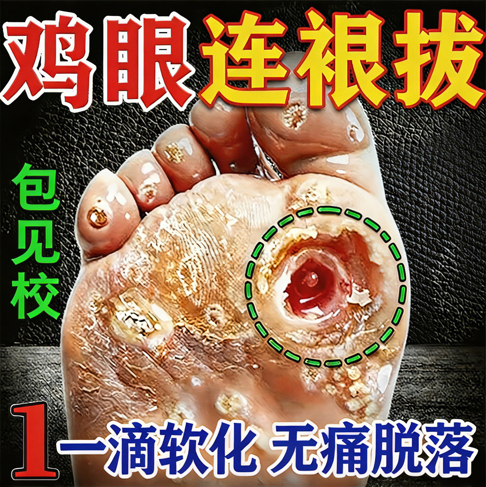 祛鸡眼膏药贴治脚底去除医用级根皮肤外用鸡茧膏效特去肉刺专用水