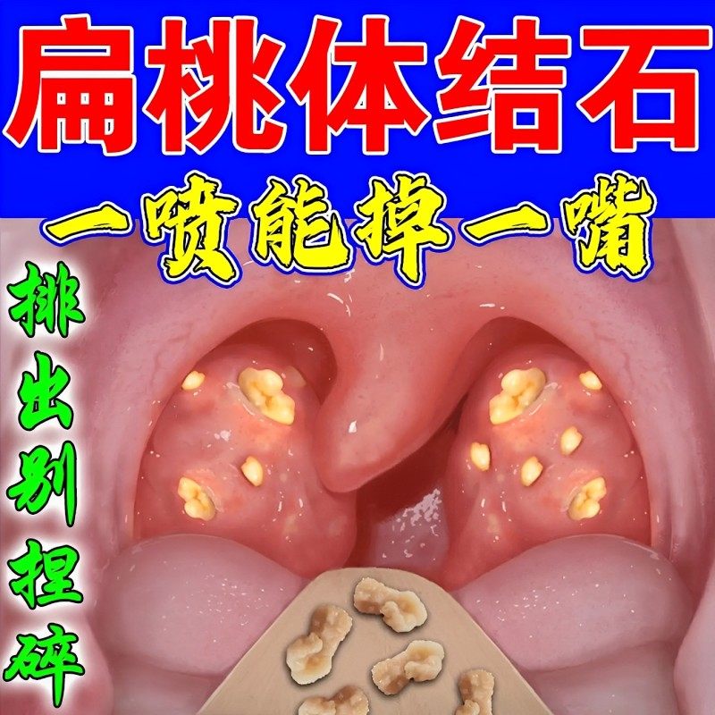 扁桃体结石去除工具喉咙结石口苦口臭隐窝冲洗器有异物感溶解喷剂