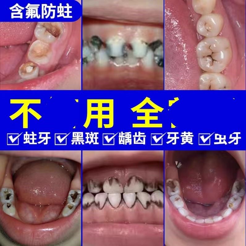 儿童牙膏含氟防蛀牙固齿龋齿修复换牙期0-3一6到12岁去牙菌斑黑牙