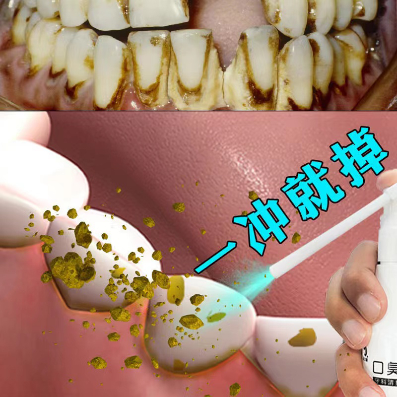 牙结石去除器溶解除牙石速效喷雾剂洗牙齿牙垢污垢牙黄清除神器溶