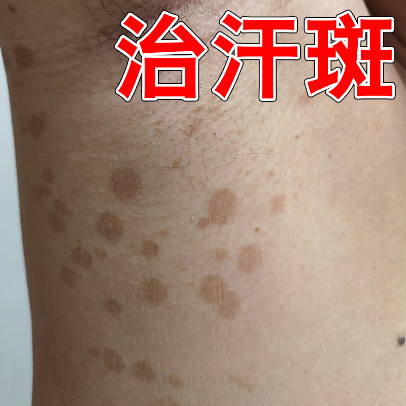汗斑净去汗斑专用去胸前后背腋下白斑花斑褐色斑止痒喷雾杀菌