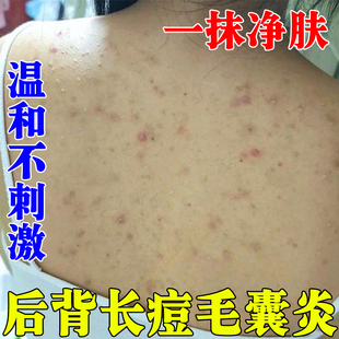 背后长痘痘后背毛囊炎去除前胸背上痘痘效特药后背除螨祛痘止痒药