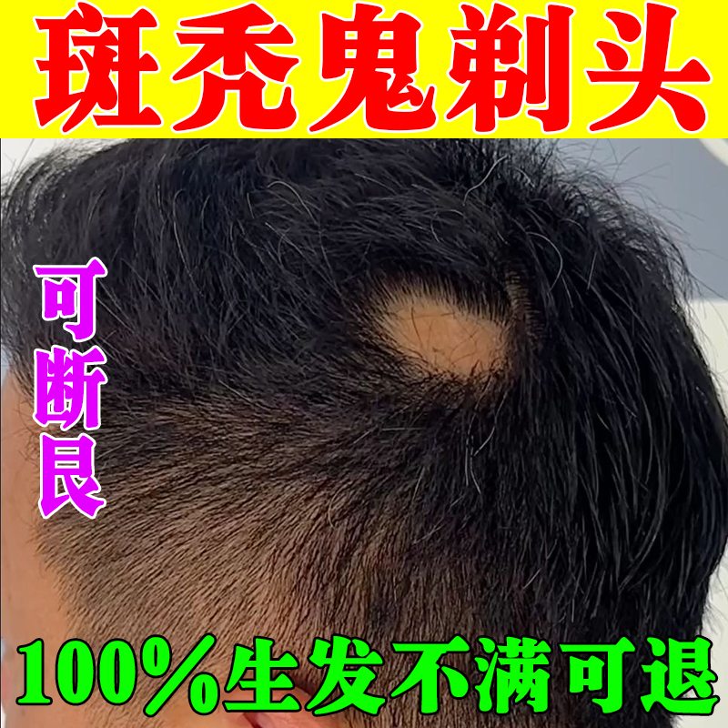 斑秃特效鬼剃头药防止脱发专用洗发水遮盖神器增发密发中药生发液
