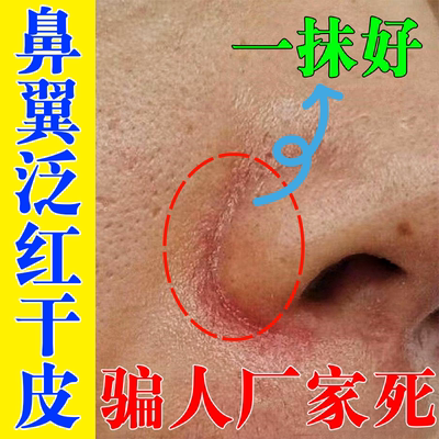 鼻子两侧发红脱皮鼻翼两边泛红干燥起皮掉皮酒糟鼻治红鼻头专用药
