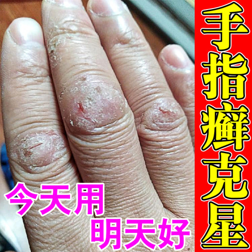 手指关节癣真菌手指头脱皮干裂长硬疙瘩手藓手气瘙痒止痒抑菌药膏