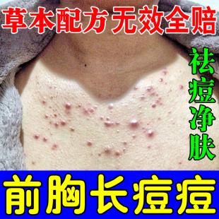 胸前痘痘胸口发红发痒长小红点疙瘩背上脓包前胸后背祛痘专用药膏