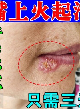 嘴唇疱疹上火起泡烂嘴角口角炎专用药膏湿疹干裂脱皮红肿痒修覆膏