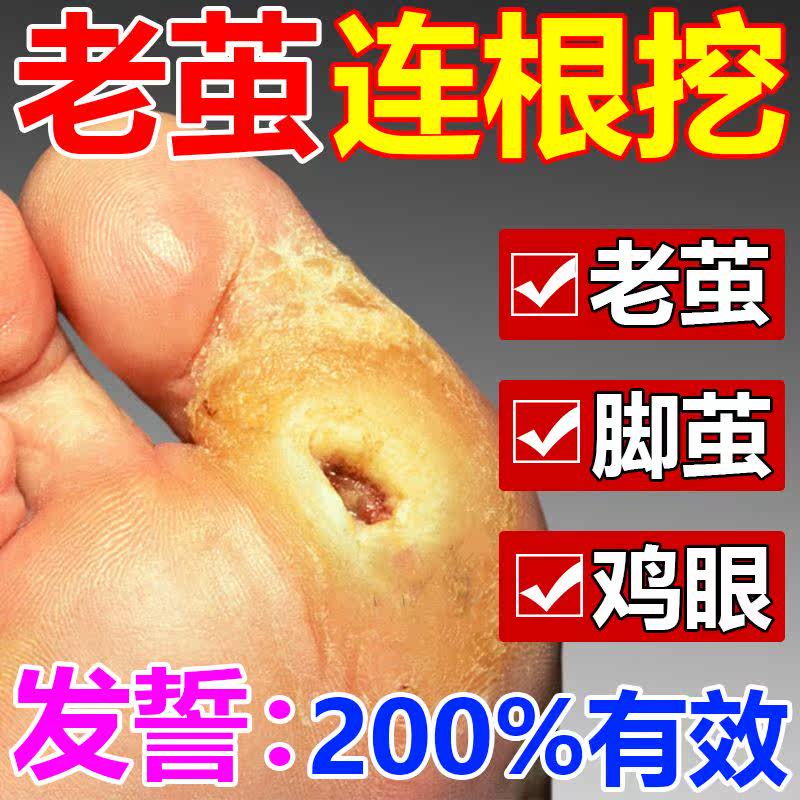 脚钉祛除膏去老茧脚底茧清安根硬厚神器死皮脚垫软化剂胼胝贴丁药