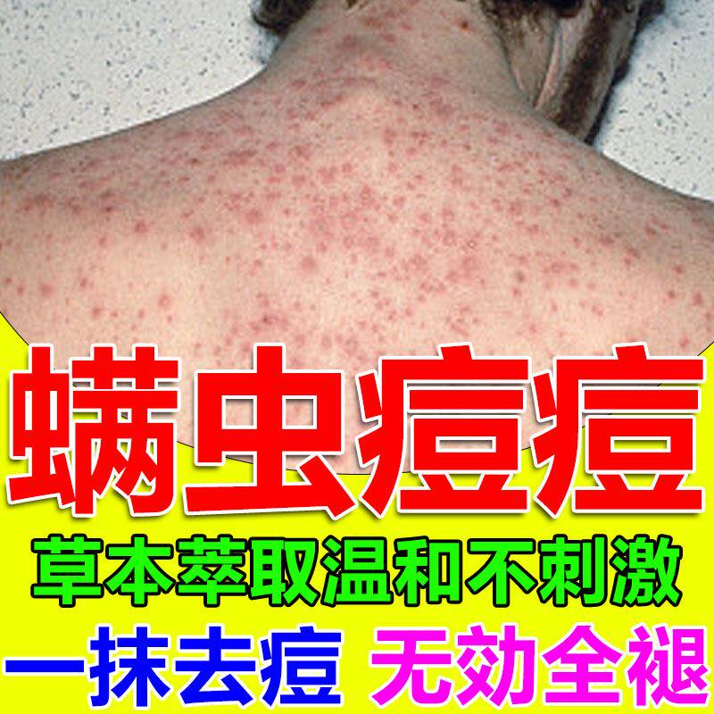 背上长痘痘后背药膏除螨虫药膏人用胸前脖子后面痘印淡化祛痘神器