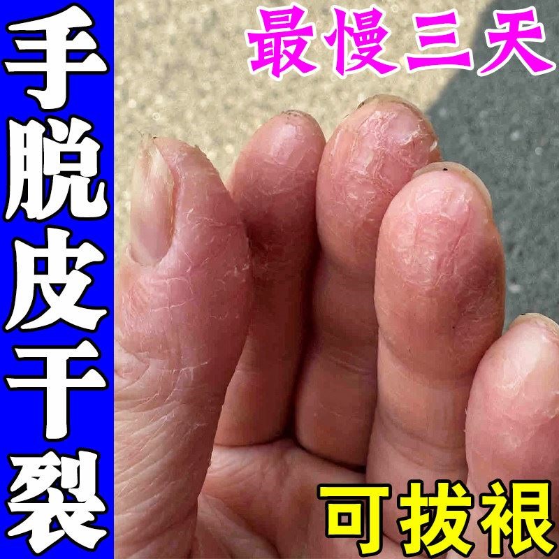 手脱皮干裂真菌蜕皮手指上起皮干燥爆皮手足蜕皮脚底开裂专用药膏