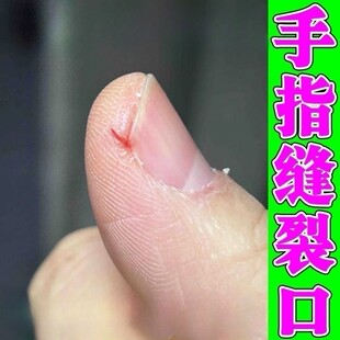 手指头裂口子干裂修复霜秋冬季指甲缝开裂脱皮疼痛防干裂愈合药膏