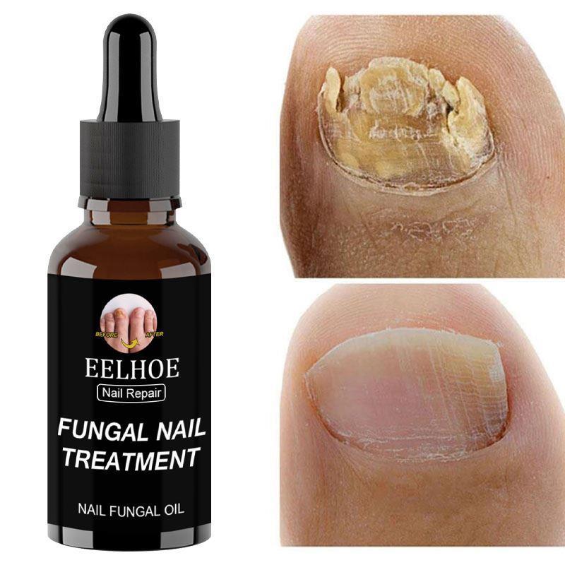 30ml Fungal Nail Repair Essence Feet CareTreatment Foot Toe